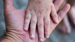 Sudan’da ilk maymun çiçeği vakası tespit edildi