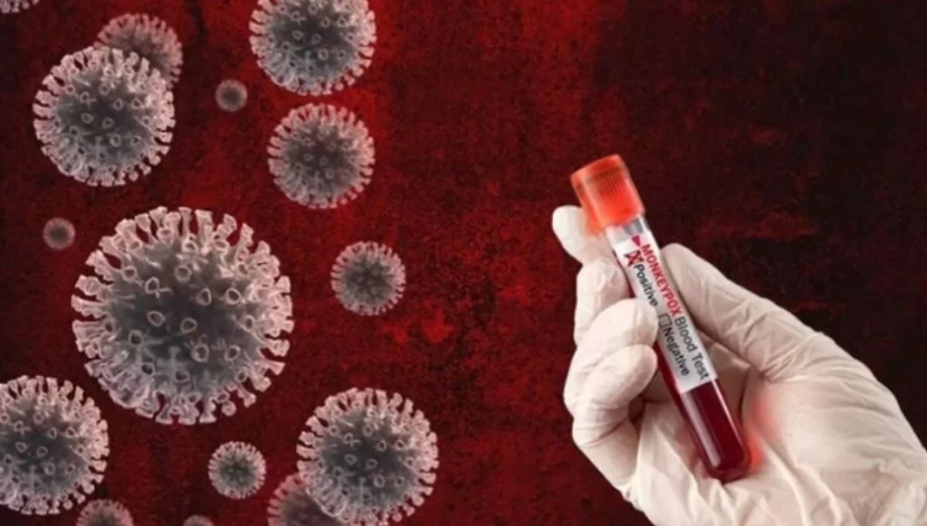 Güney’de maymun çiçeği vakası!